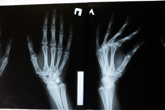 Cita prèvia amb el Dr. Padrós: la IA ja llegeix radiografies d'ossos trencats