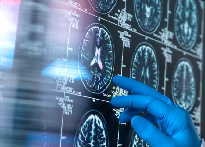 Imagen de Cita prèvia amb el doctor Padrós -  Avenços per detectar l'Alzheimer i la longevitat