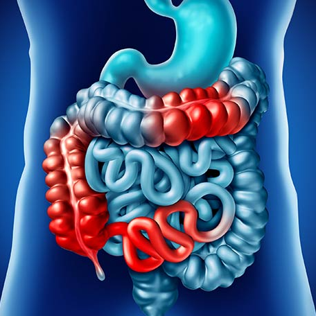 La enfermedad del Crohn aumenta y afecta ya a unas 3.000 personas en Navarra